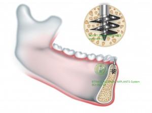 Implante Basal Roott