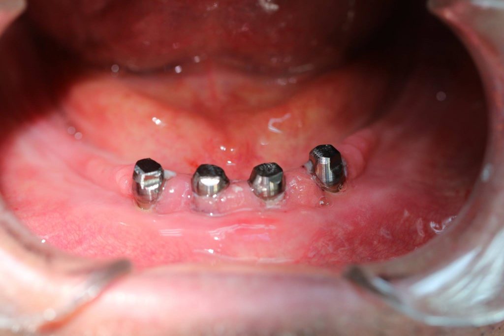 Implantes Dentales Dr.Rey